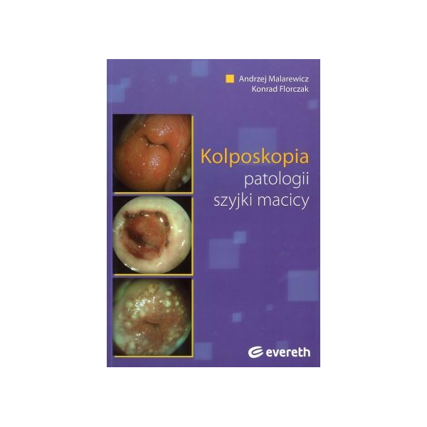 Kolposkopia patologii szyjki macicy