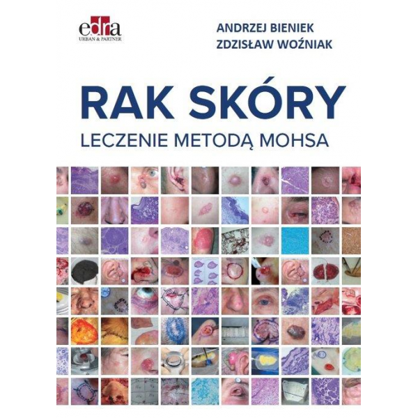 Rak skóry Leczenie metodą Mohsa Rak skóry Leczenie metodą Mohsa