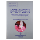 Laparoskopowe wycięcie macicy