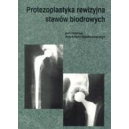 Protezoplastyka rewizyjna stawów biodrowych