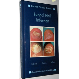 Fungal Nail Infection Pocket Picture Guides (wersja angielska)