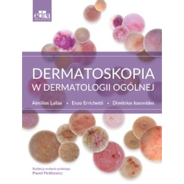 Dermatoskopia w dermatologii ogólnej