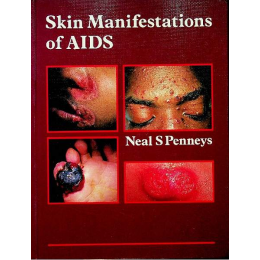Skin Manifestations of AIDS