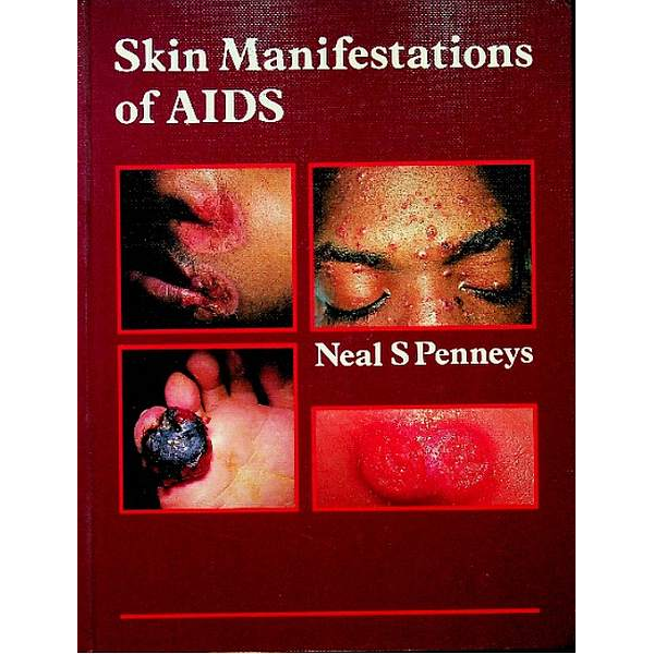 Skin Manifestations of AIDS