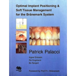 Optimal Implant Positioning & Soft Tissue Management for the Branemark System 