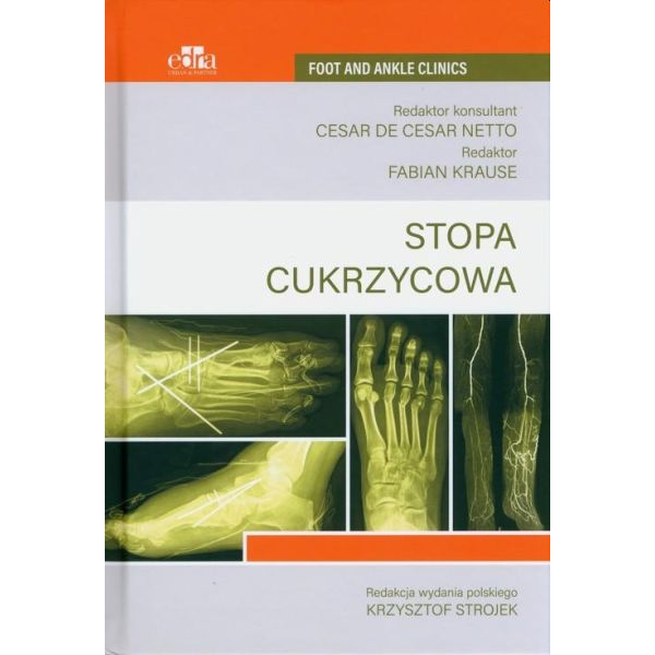 Stopa cukrzycowa