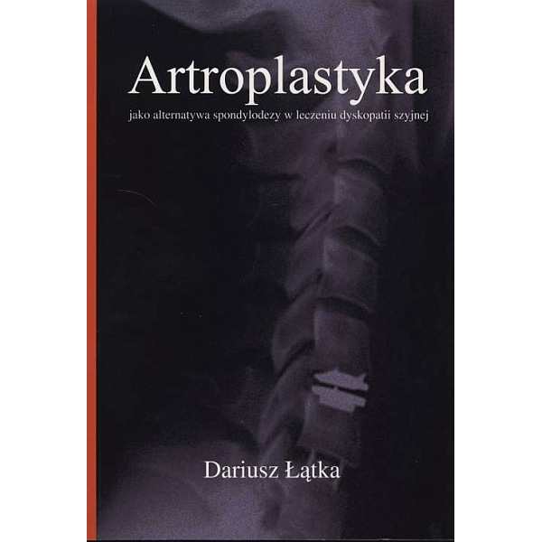 Artroplastyka jako alternatywa spondylodezy w leczeniu dyskopatii szyjnej Artroplastyka jako alternatywa spondylodezy w leczeniu dyskopatii szyjnej