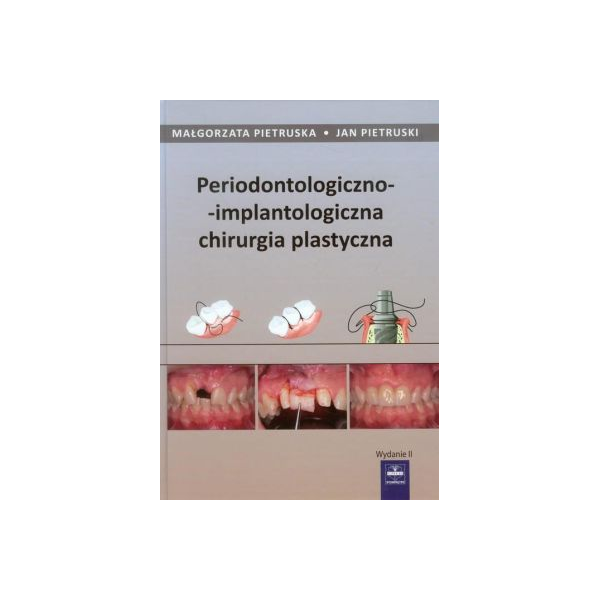 Periodontologiczno-implantologiczna chirurgia plastyczna