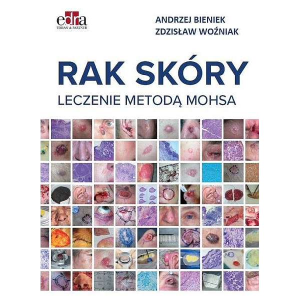 Leczenie skóry leczenie modą MOHSA